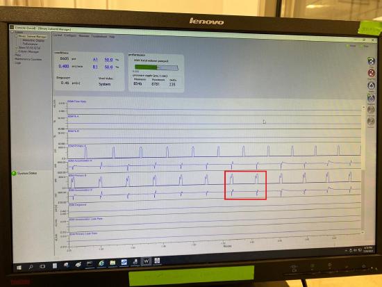 Abnormal Pressure Trace.jpg